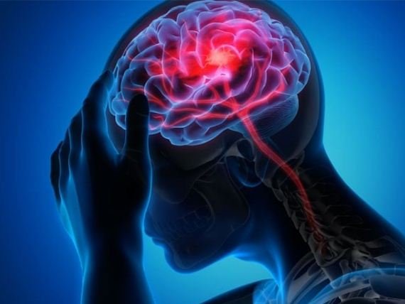 By 2050, The Number Of Deaths Due To Stroke Will Reach One Crore