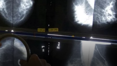 The Age For Breast Cancer Screening Will Be Reduced From 50 To 40