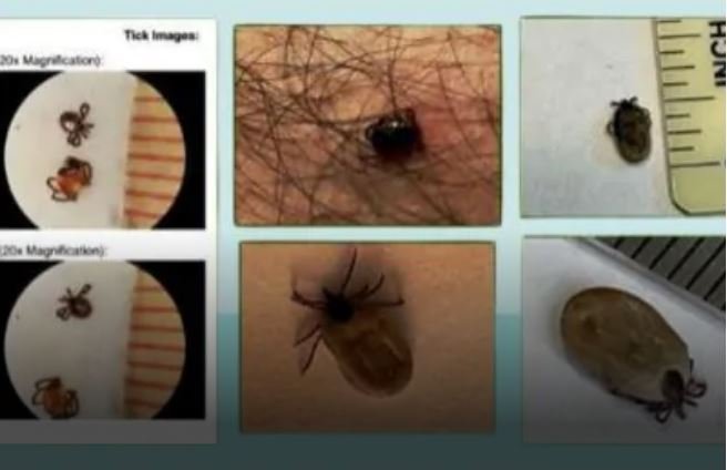 Tick-Borne Diseases