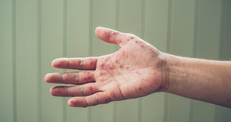 Measles