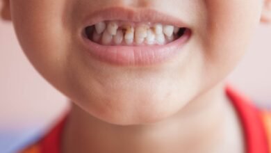 Pediatric dentist applying silver diamine fluoride treatment to a young child's decayed tooth.